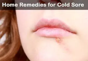 Home Remedy for Cold Sore