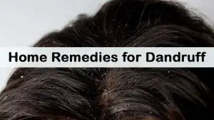 Home Remedies for Dandruff