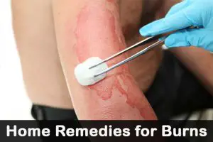 Home Remedy for Burns