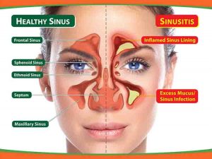 Home Remedies for Sinus Infection