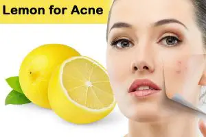 Lemon for Acne