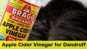 Apple Cider Vinegar for Dandruff