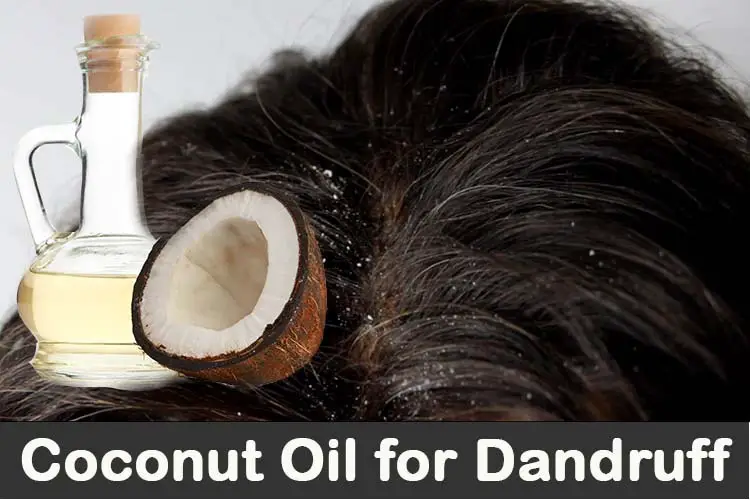 Coconut Oil for Dandruff