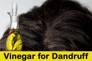 Vinegar for Dandruff