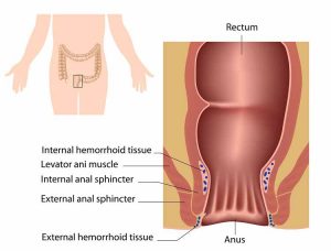 Home Remedies for hemorrhoids