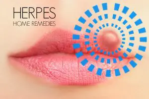 herpes home remedies