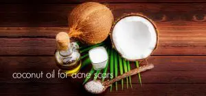 coconut oil for acne scars