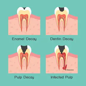 tooth abscess stages