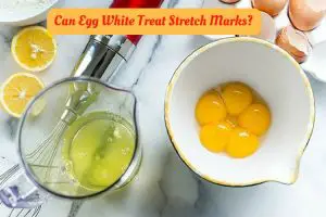 Egg White For Stretch Marks