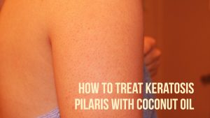 Coconut Oil For Keratosis Pilaris