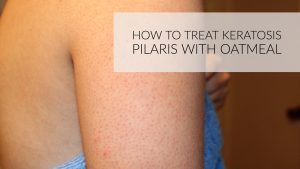 Oatmeal For Keratosis Pilaris