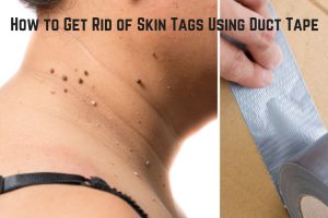 How to Remove Skin Tags Using Duct Tape