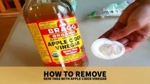 Apple Cider Vinegar For Skin Tags