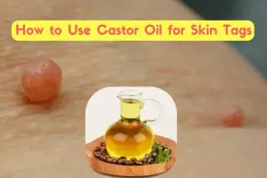Does Castor Oil Remove Skin Tags