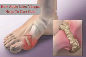 How to Use Apple Cider Vinegar for Gout