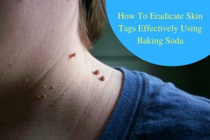 How to Use Baking Soda for Skin Tags