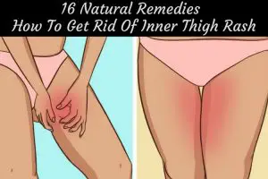 Home Remedies to Get Rid of Inner Thigh Rash