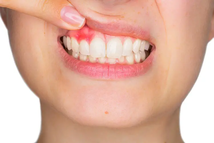 tooth abscess symptoms